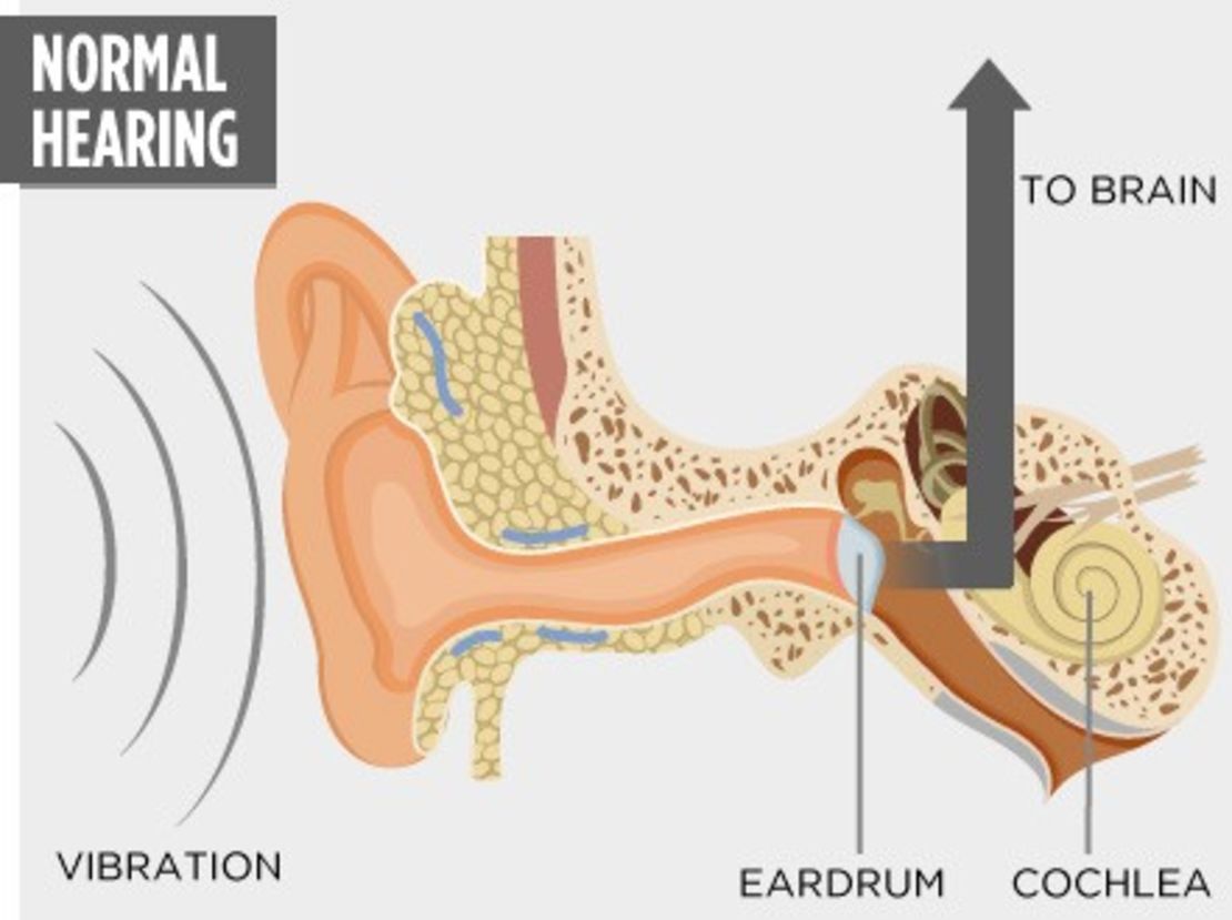 Sound vibrations pass from the outer ear, through the eardrum to the cochlea, which transmits them to the brain as electrical signals.