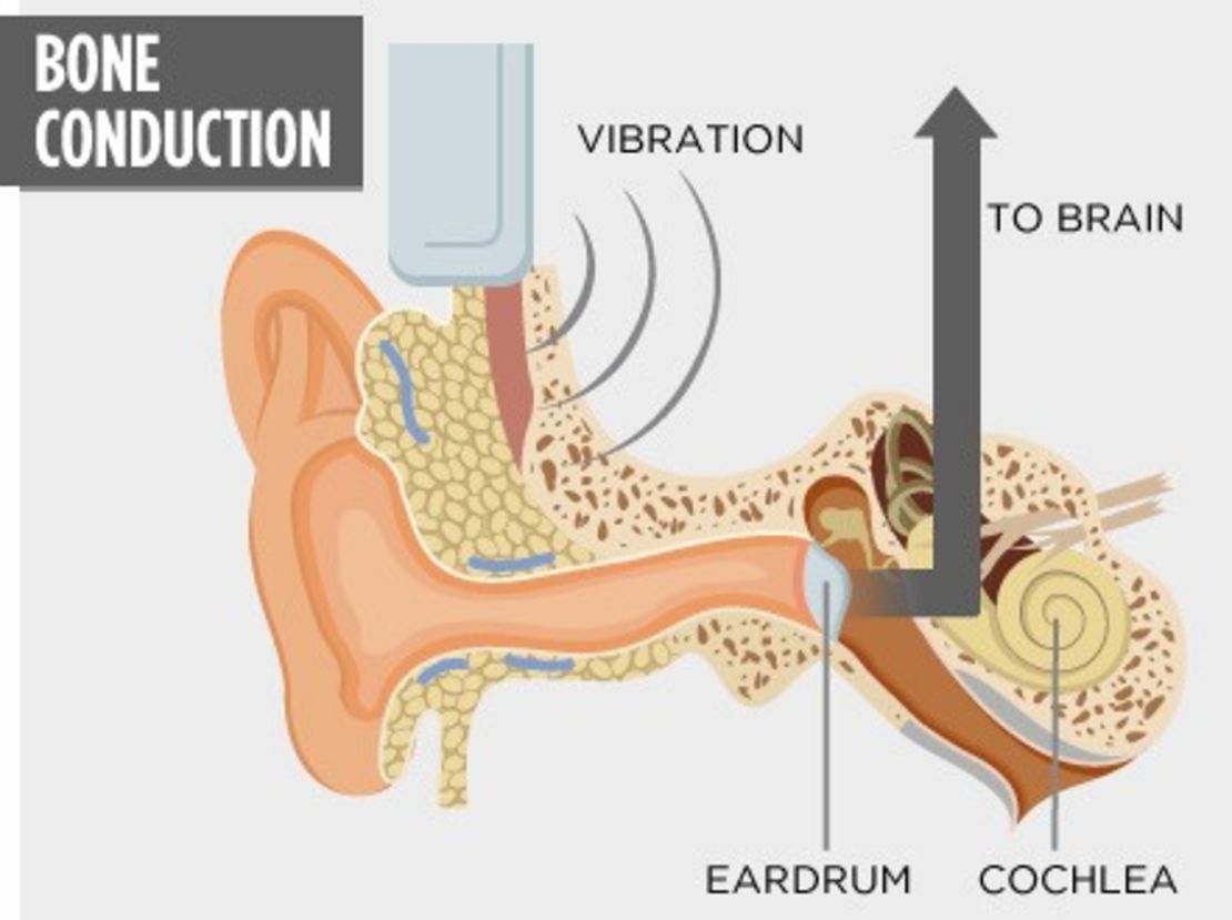 A transducer is used to convert sound into bone vibrations that transmit directly to the cochlea and on to the brain, bypassing the outer ear and eardrum.