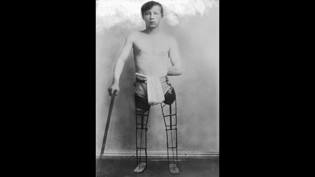 German soldier with simple artificial legs, 1917.   