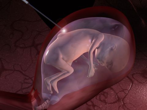 Researchers are developing a three-armed robot to perform keyhole surgery to correct congenital defects on babies in the womb.