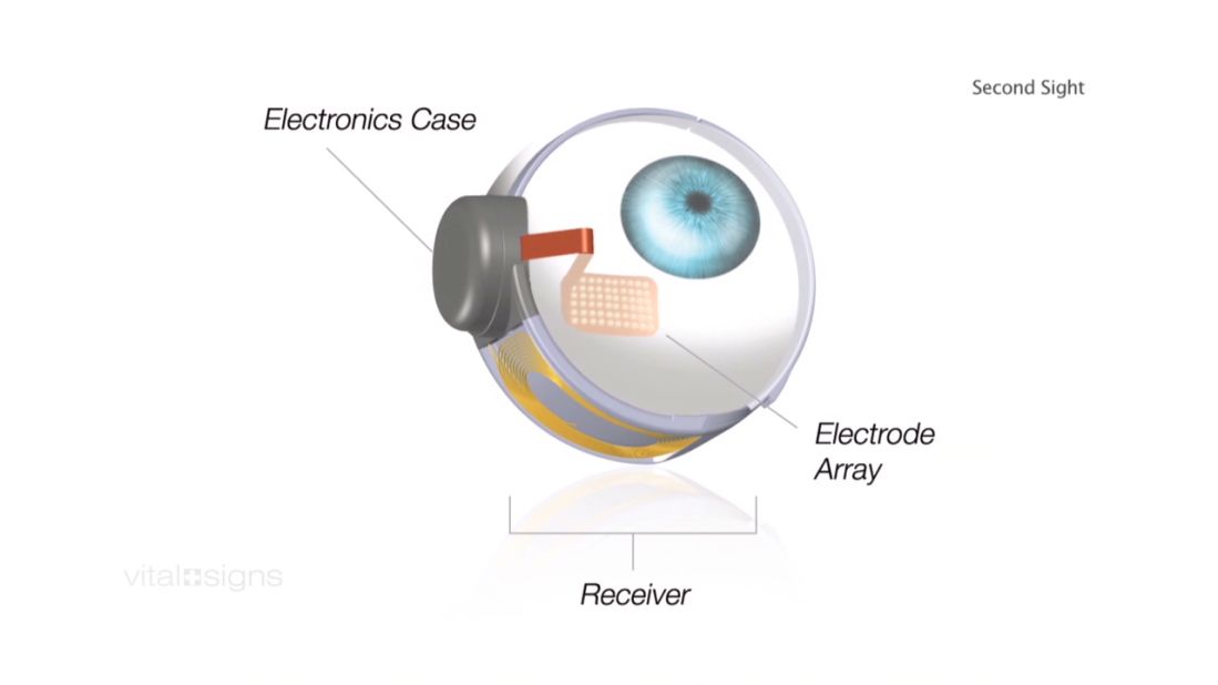 Visual information from the camera is transmitted wirelessly to electrodes on the artificial retina, where it is converted to electrical pulses.