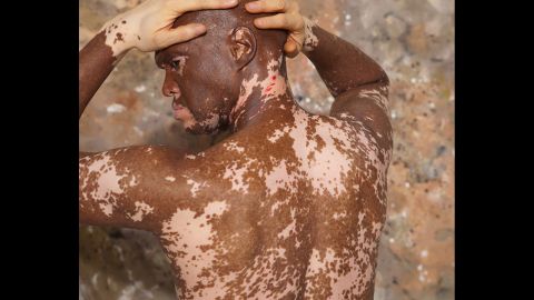 Lee Thomas, pictured, said vitiligo challenged his personal identity as an African-American man. Darkness is a sign of strength, he said, and it was a process to acknowledge that he didn't lose his identity. "Color has nothing to do with the integrity of who I am," Thomas said.