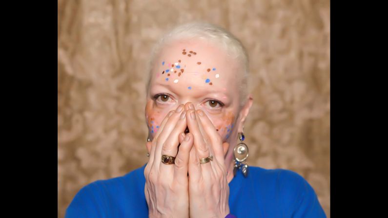 Vitiligo affects roughly 100 million people worldwide, according to the <a href="index.php?page=&url=http%3A%2F%2Fvrfoundation.org%2F" target="_blank" target="_blank">Vitiligo Research Foundation</a>. Pictured, Teri Martin.