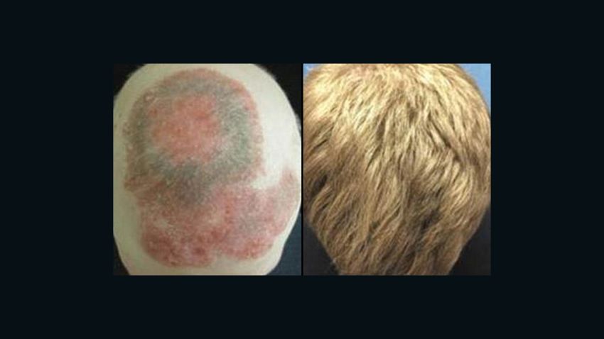 These panels show the patient's head before treatment, left, and eight months into treatment.