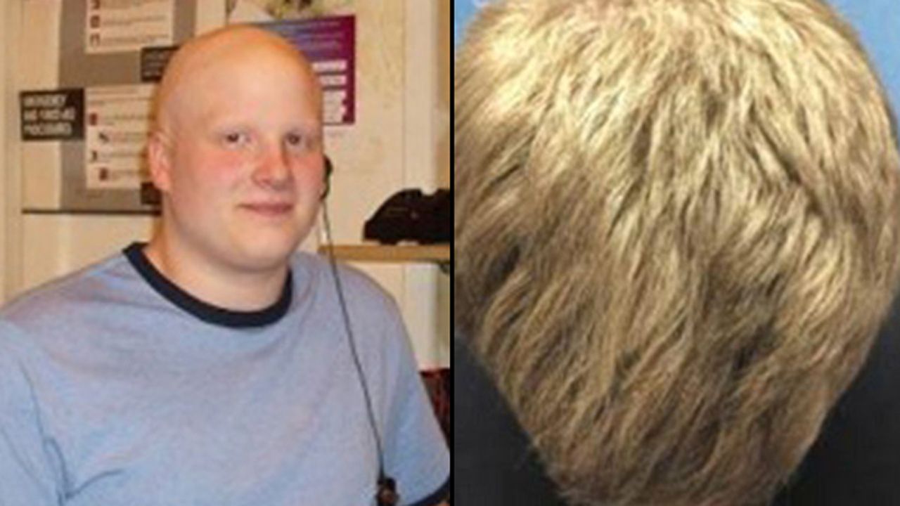 Kyle Rhodes had a full head of hair after eight months when he began using an arthritis drug to treat his alopecia areata.
