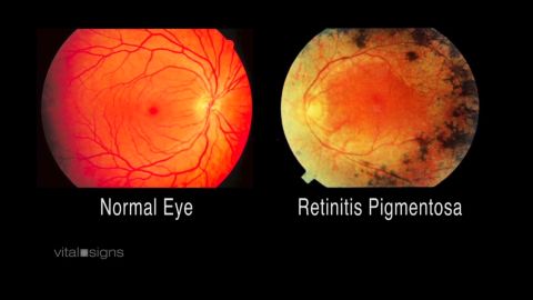 Retinitis pigmentosa causes a slow loss of light-sensitive retinal cells.