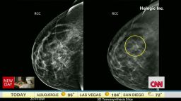 newday intv gupta 3d mammogram_00005406.jpg