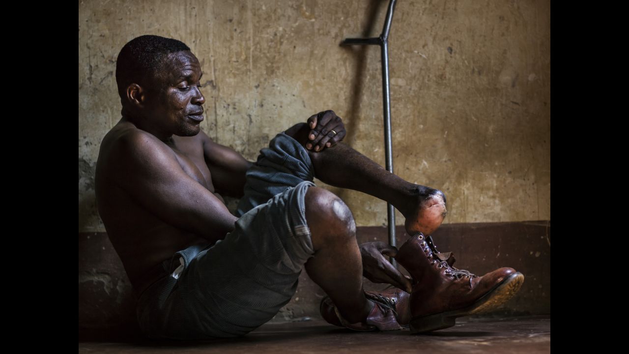 Matteo Muxambo lost his foot in 1995. He was walking along a trail near the Mozambique-Zimbabwe border when he stepped off the path to allow a woman to pass. He was blown back by an anti-personnel mine, which took off his foot and severely injured the passing woman.