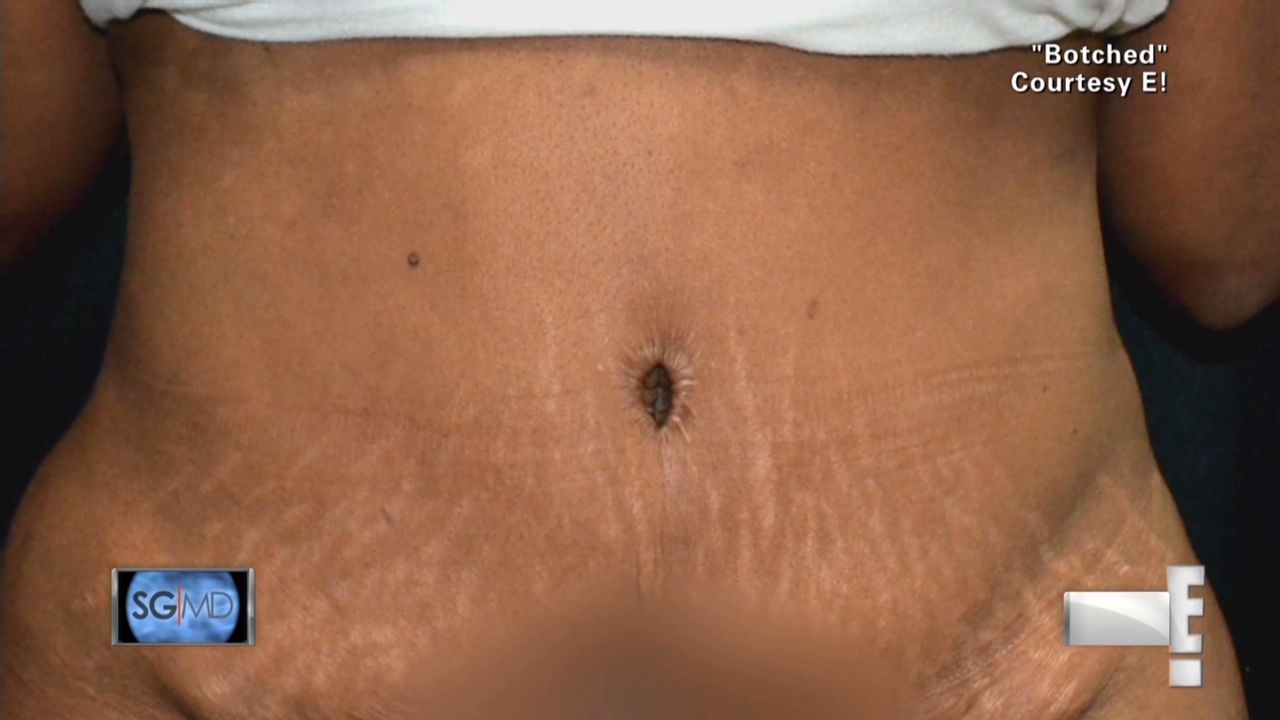 Abdominoplasty gone wrong. : r/Botchedsurgeries