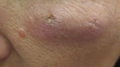 Dr. Richard Glogau says tests showed there was some type of "refractile material" found in his patient's cheeks.