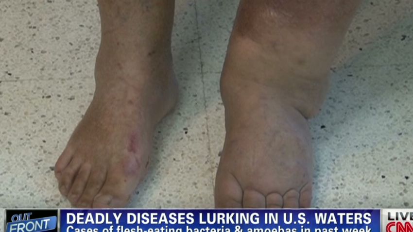 erin pkg marquez flesh eating bacteria_00011217.jpg