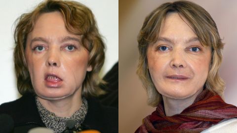 Isabelle Dinoire a few months after her surgery, left, and a year later.