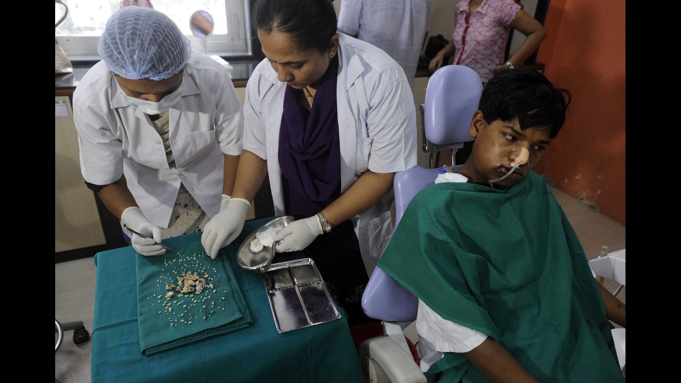 Dentists in Mumbai, India, display teeth that were removed from the mouth of 17-year-old Ashik Gavai on Tuesday, July 22. Surgeons removed 232 teeth from Gavai's mouth in what they believe might be a world-record operation. Gavai sought medical help for swelling on the right side of his lower jaw, and he was found to be suffering from a condition known as complex odontoma, the head of dentistry told Agence France-Presse.
