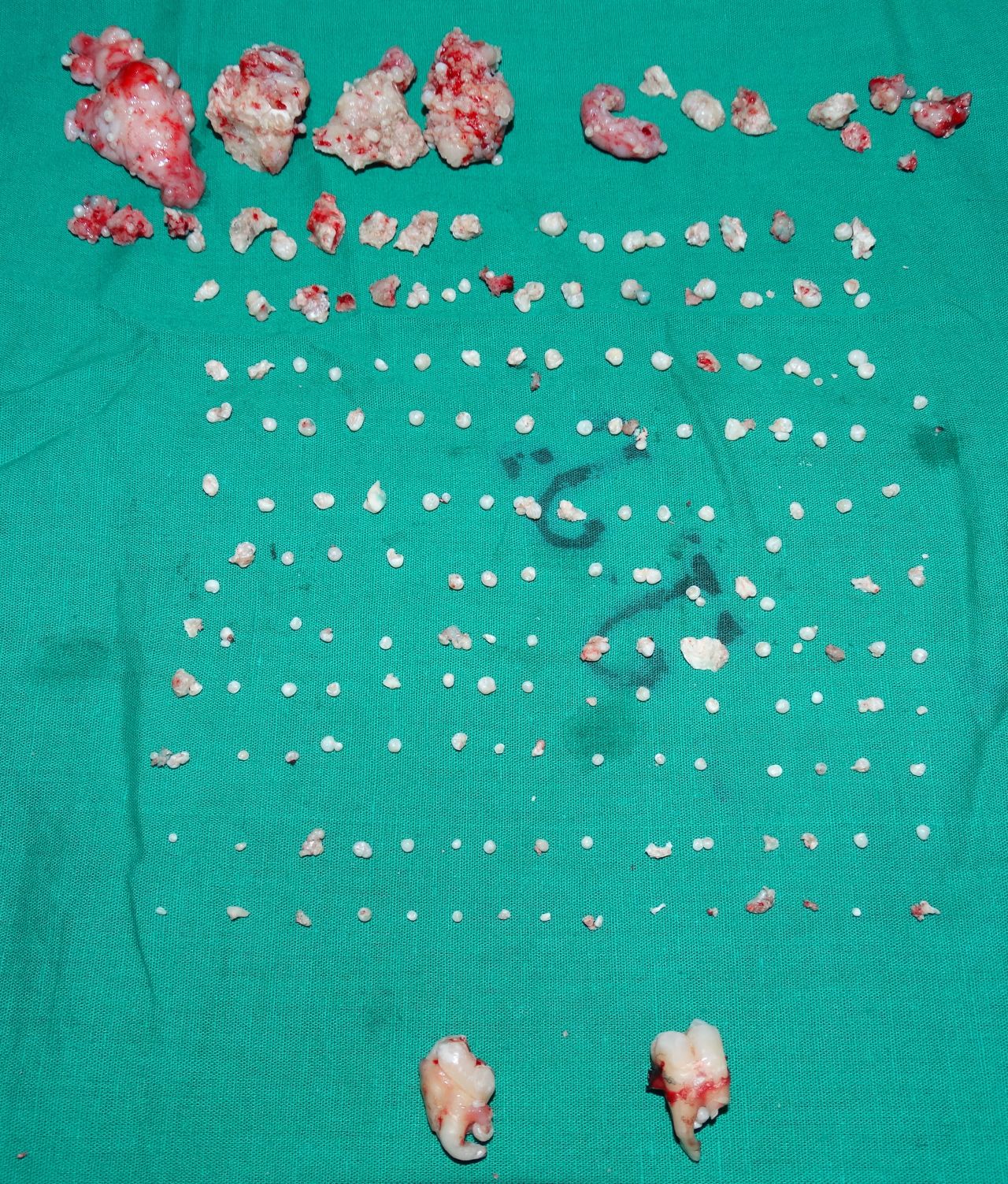 The teen had 232 denticles removed -- doctors said it was a dangerous operation.