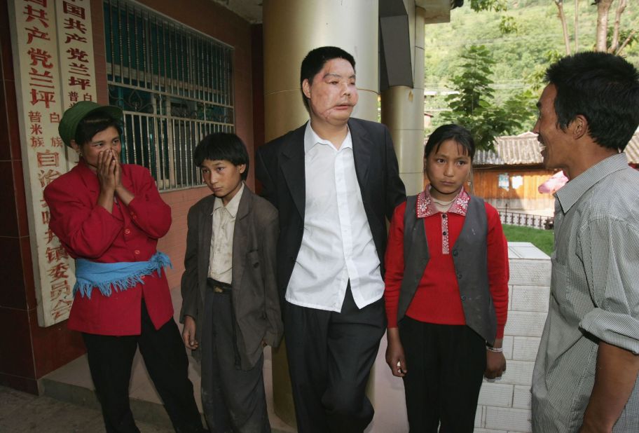 Li Guoxing, China's first partial face transplant patient, stands with his family in 2006. He died in 2008.