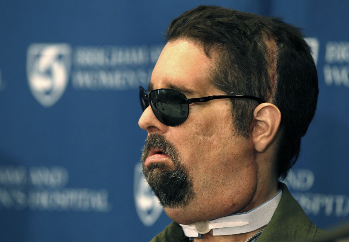 Texan Dallas Wiens, whose face was burned off after his head touched an electrical wire, was the first American to receive a full face transplant in March 2011. 