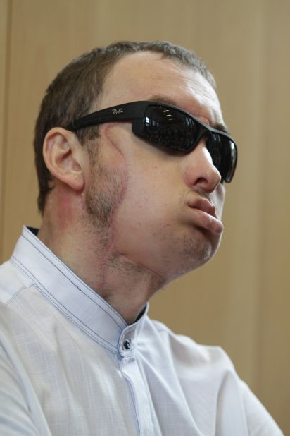 A 33-year-old Polish man identified only as Grzegorz received the country's first face transplant in May 2013, after being disfigured by a machine at a stonemason's workshop. Polish doctors described it as the world's first life-saving face transplant.