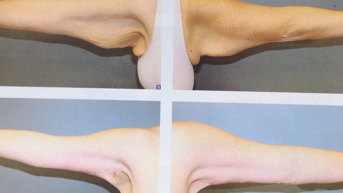A surgeon removed the excess skin left behind on Miller's arms following her weight loss.