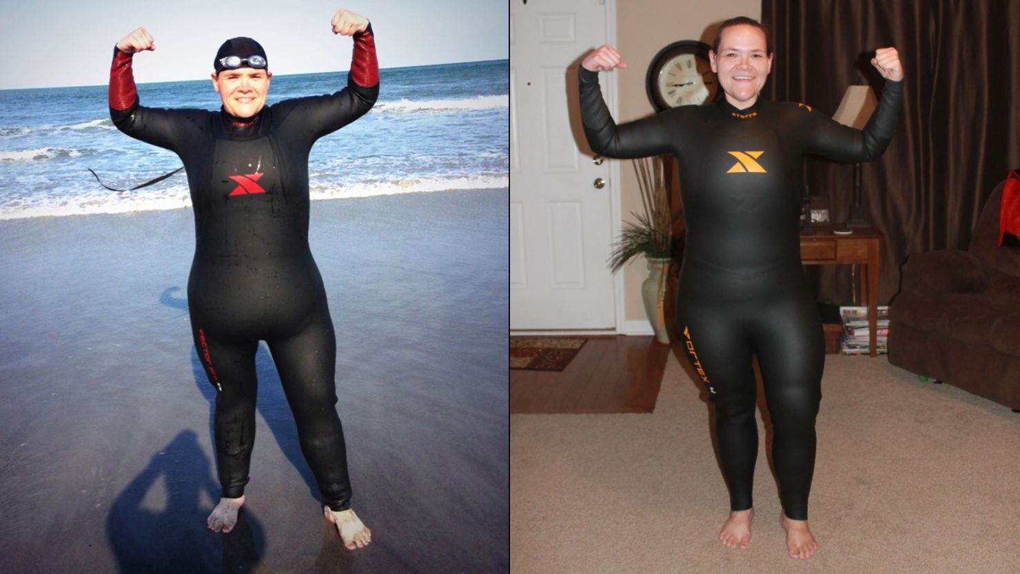 Annette Miller hated how the excess skin around her stomach looked in a wet suit before surgery. 