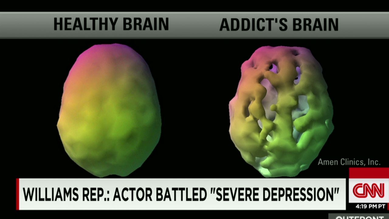 exp erin intv amen robin williams addition brain scans_00002001.jpg