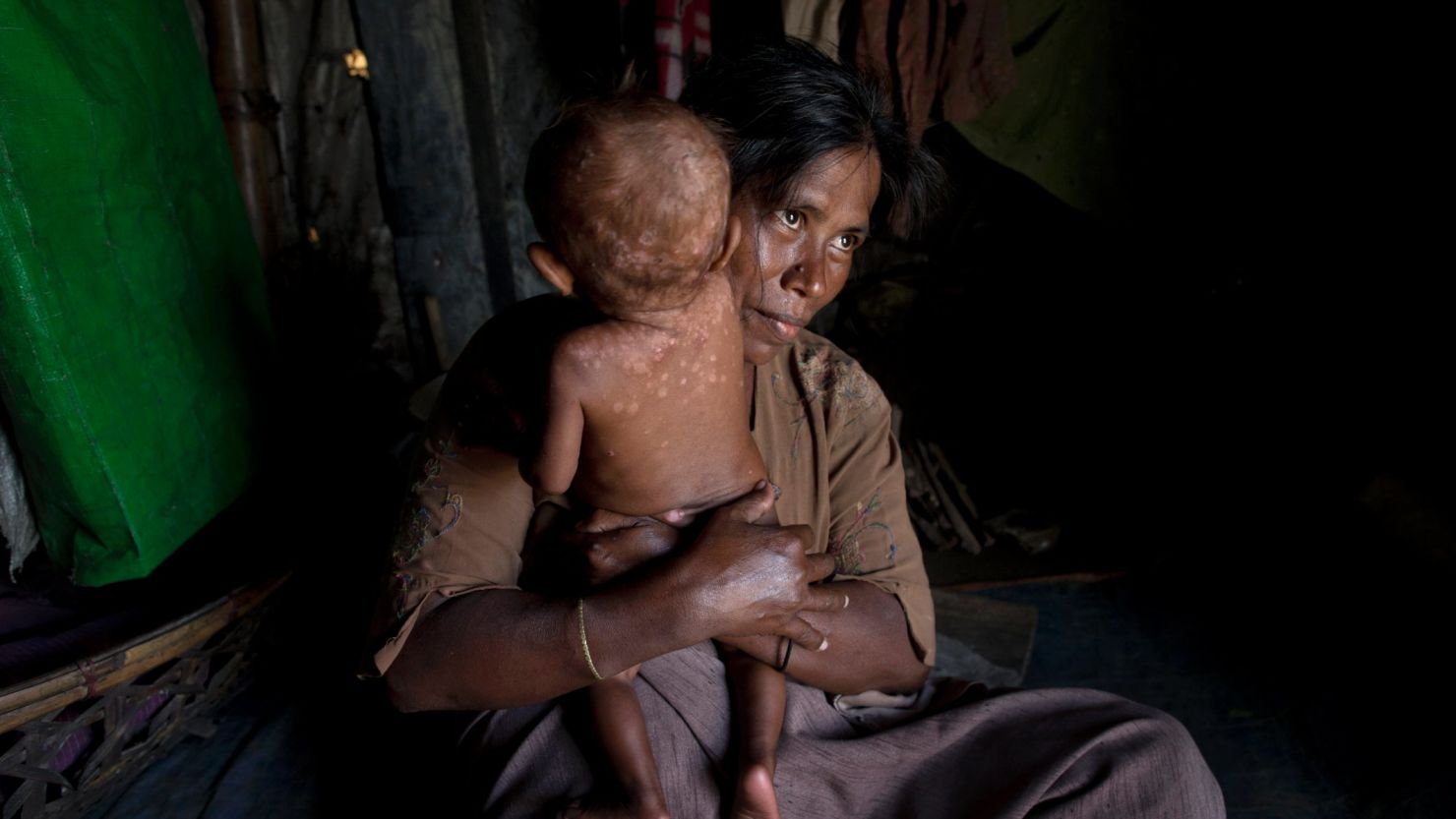 A Rohingya refugee holds her daughter who suffers from a skin disease at Dar Paing camp, Rakhine, Myanmar.