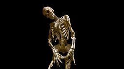 The Skeleton of Harry Eastlack, Fibrodysplasia Ossificans Progressiva (FOP)
Evi Numen, 2011, for the Mütter Museum of The College of Physicians of Philadelphia
