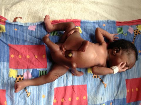 Baby Paul Mukisa was born with a "parasitic twin," a conjoined twin that did not fully develop.