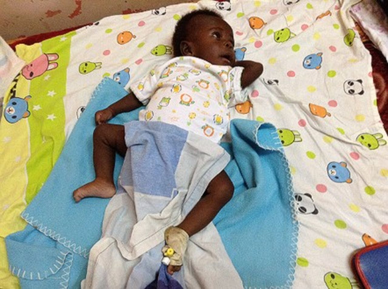 Baby boy Paul Mukisa after the operation. - (DR KAKEMBO NASSER)