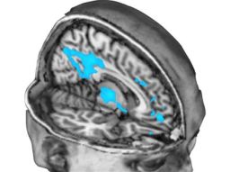 Decreased blood flow under the influence of psilocybin in regions of the brain that are known to integrate information and mediate conscious states.
