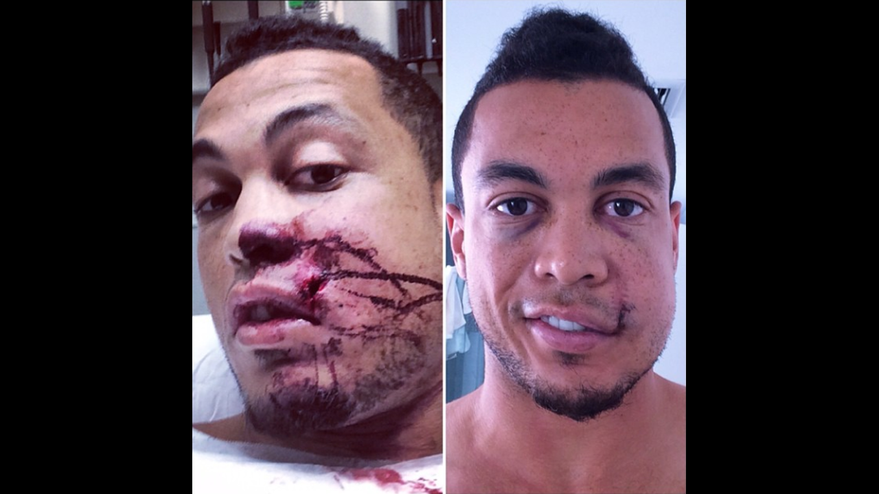 Giancarlo Stanton, an All-Star baseball player with the Miami Marlins, <a href="http://instagram.com/p/tA6J_NQ6lg/" target="_blank" target="_blank">posted photos of himself</a> after a pitch hit him in the face Thursday, September 11, in Milwaukee. "Making huge progress!!" he wrote on Instagram. "Want to thank everyone who has played a part in my recovery process. Your kind messages, thoughts & prayers have meant the world to me."