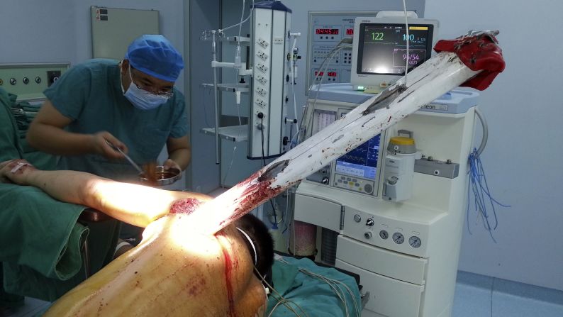 A doctor in Zhumadian, China, performs surgery Monday, September 15, on a man who had part of an aluminum-alloy fence pierce his body during a car accident. The man survived after the piece of fence was surgically removed.