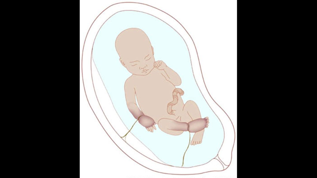 Amniotic band syndrome is a condition where stringlike bands extend from the inner lining of the amnion, the sac that surrounds the baby in the womb. As the baby develops, its extremities may become entangled in these bands.