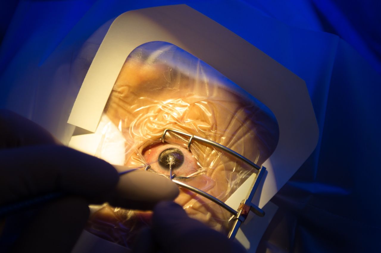 Close up of the procedure at the LASIK Surgery Clinic (LSC) in Singapore.