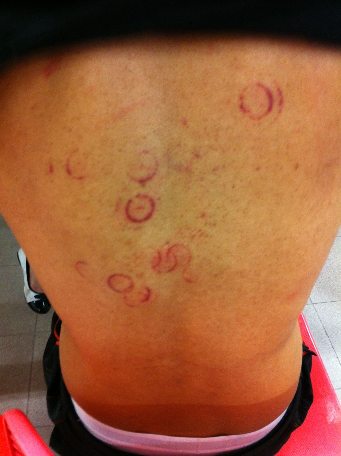 Welts on Tsang's back.