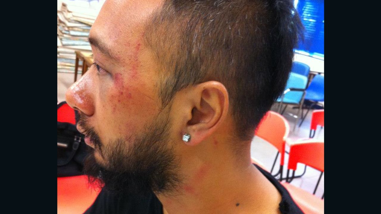 Tsang displays bruising to his face following an alleged police assault.