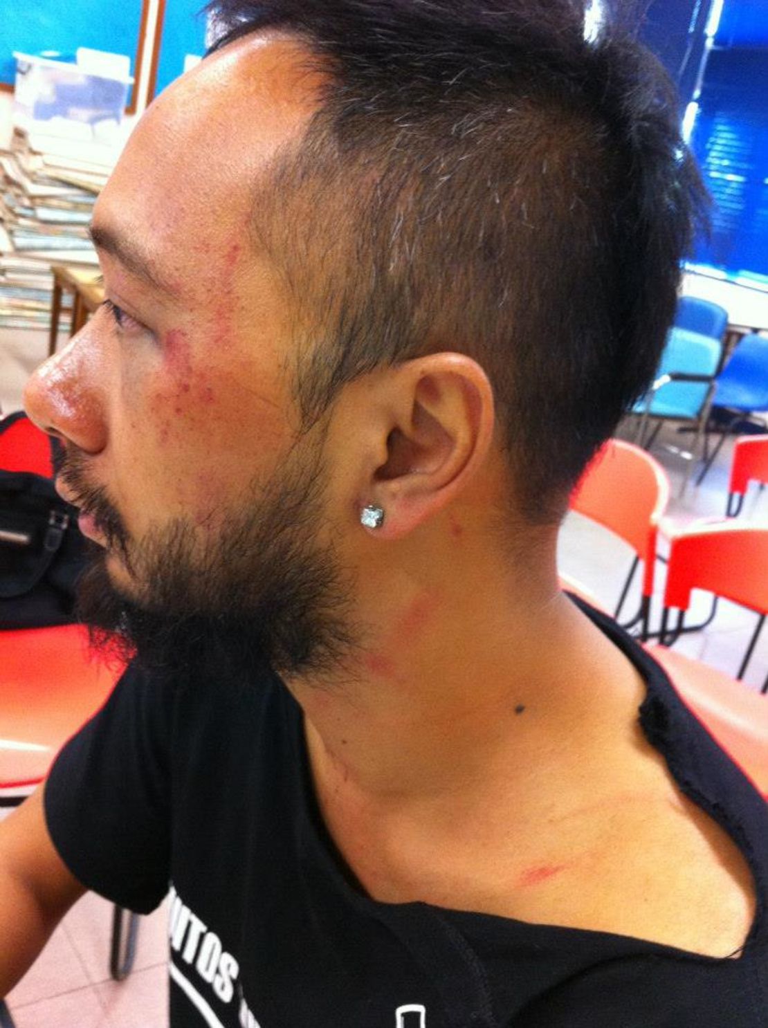 Tsang displays bruising to his face following an alleged police assault.