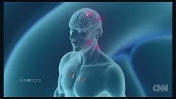 deep brain stimulation graphic 3