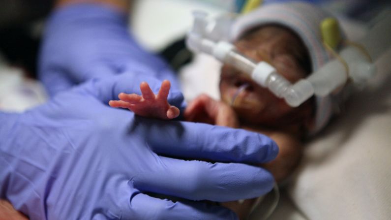 "Las tasas de supervivencia (entre los bebés prematuros) mejoran", dijo Mindy Morris, una practicante de enfermería neonatal en el Hospital Infantil. "Así que pueden sobrevivir para ser dados de alta. Pero al crecer tienen muchas complicaciones".
