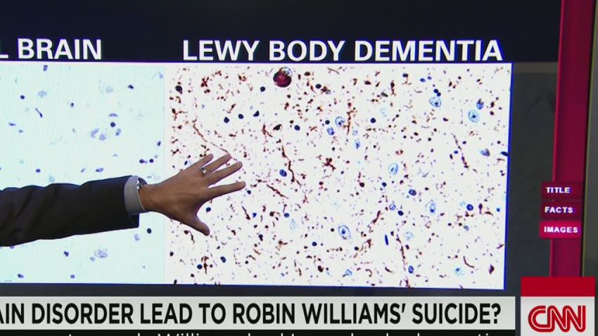 erin gupta williams had lewy body dementia_00013308.jpg