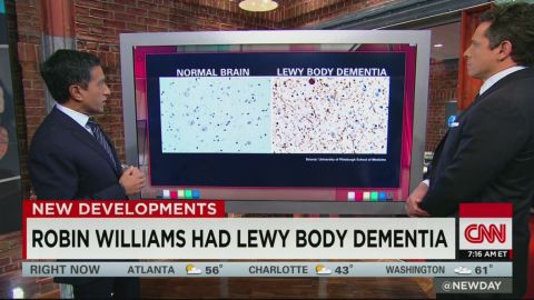 newday gupta lewy body dementia_00001715.jpg