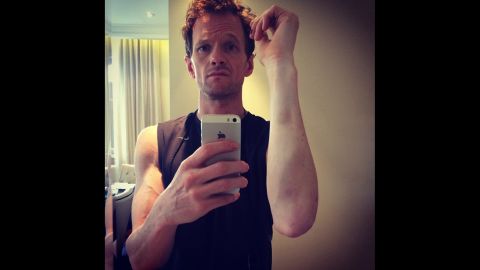 "Almost broke off my arm during a show last week," actor Neil Patrick Harris said in <a href="http://instagram.com/p/qfCCDFyTjg/" target="_blank" target="_blank">this selfie he posted to Instagram</a> on Tuesday, July 15. "Gots the bruises to prove it. Hedwig's outta control. #battlescars." Harris was referring to the Broadway show "Hedwig and the Angry Itch."