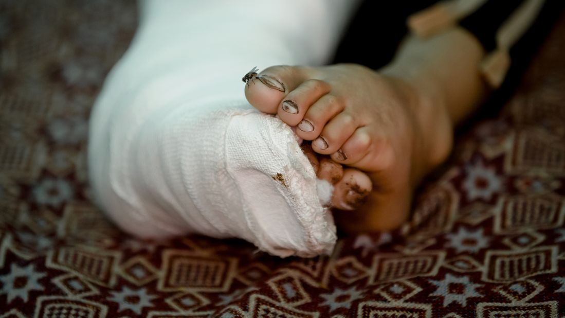 A fly lands on the toe of 8-year-old Mahmut Munir, a Syrian Kurdish refugee boy from Kobani, inside a tent in Suruc on November 19. The boy was reportedly injured in a mortar attack by ISIS militants.