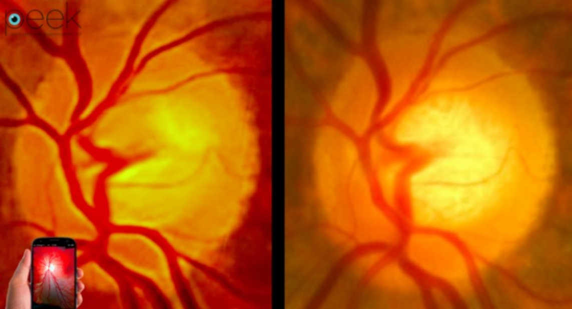 Peek Retina's comparison image.