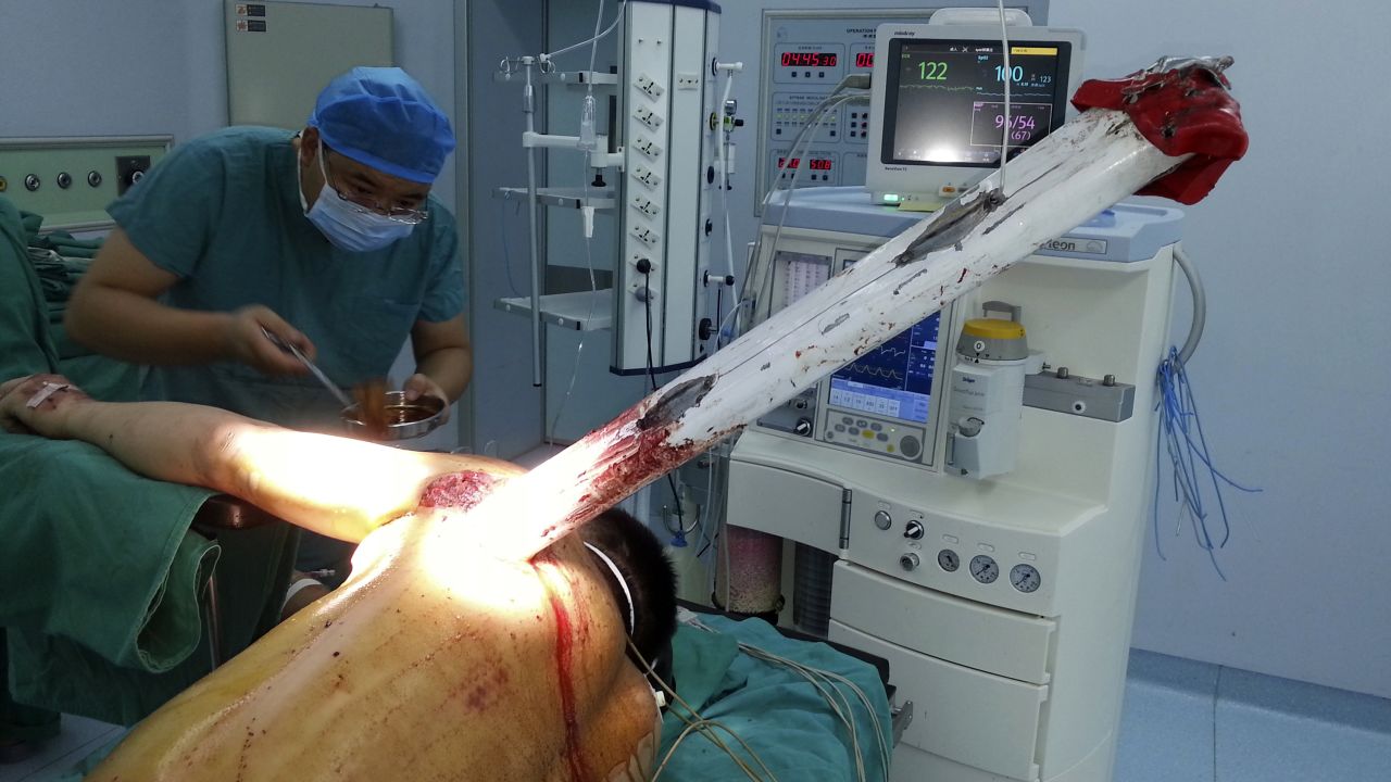 <strong>September 15:</strong> A doctor in Zhumadian, China, performs surgery on a man who had part of an aluminum-alloy fence pierce his body during a car accident. The man survived after the piece of fence was surgically removed.