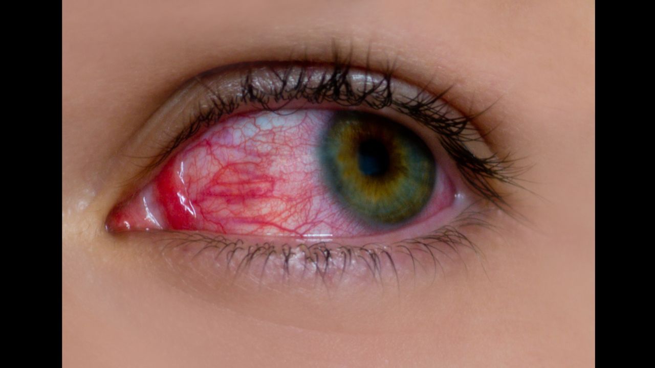 Childhood uveitis is a rare disease that can cause blindness if not treated early. 