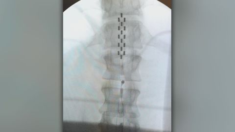 Electrodes planted on a paralyzed man's spine help him move his leg.