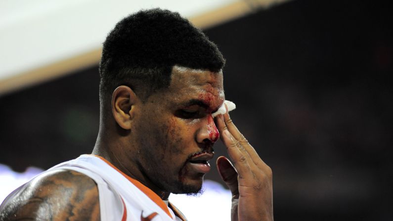Texas basketball player Cameron Ridley treats a cut Tuesday, December 23, during the Longhorns' 74-71 home loss to Stanford.