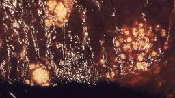 1986

This photomicrograph revealed the presence of multiple granulomas in a gross specimen of human liver tissue, which had been caused by an invasive case of <i>Candida albicans</i> fungal organisms.

Candidiasis is a fungal infection caused by yeasts that belong to the genus <i>Candida</i>. There are over 20 species of <i>Candida</i> yeasts that can cause infection in humans, the most common of which is <i>Candida albicans</i>. <i>Candida</i> yeasts normally live on the skin and mucous membranes without causing infection; however, overgrowth of these organisms can cause symptoms to develop. Symptoms of candidiasis vary depending on the area of the body that is infected.<p>Candidiasis that develops in the mouth or throat is called “thrush” or oropharyngeal candidiasis. Candidiasis in the vagina is commonly referred to as a “yeast infection.” Invasive candidiasis occurs when <i>Candida</i> species enter the bloodstream and spread throughout the body. Click the links below for more information on the different types of Candida infections.