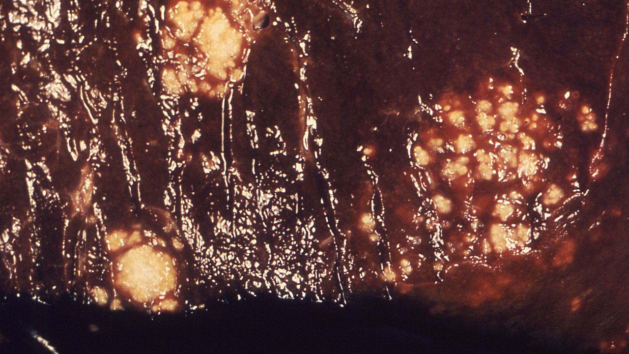 1986

This photomicrograph revealed the presence of multiple granulomas in a gross specimen of human liver tissue, which had been caused by an invasive case of <i>Candida albicans</i> fungal organisms.

Candidiasis is a fungal infection caused by yeasts that belong to the genus <i>Candida</i>. There are over 20 species of <i>Candida</i> yeasts that can cause infection in humans, the most common of which is <i>Candida albicans</i>. <i>Candida</i> yeasts normally live on the skin and mucous membranes without causing infection; however, overgrowth of these organisms can cause symptoms to develop. Symptoms of candidiasis vary depending on the area of the body that is infected.<p>Candidiasis that develops in the mouth or throat is called “thrush” or oropharyngeal candidiasis. Candidiasis in the vagina is commonly referred to as a “yeast infection.” Invasive candidiasis occurs when <i>Candida</i> species enter the bloodstream and spread throughout the body. Click the links below for more information on the different types of Candida infections.