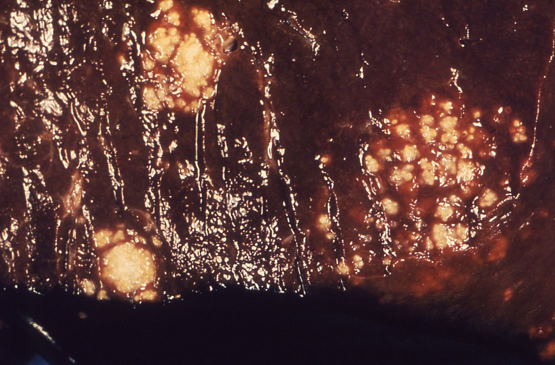 Candida albicans infects a human liver. Invasive candidiasis occurs when Candida species enter the bloodstream and spread throughout the body.